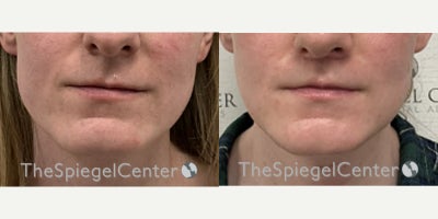 25-34 year old transgender woman treated with Transgender Facial Feminization Surgery - 25-34 year old transgender woman treated with Transgender Facial Feminization Surgery