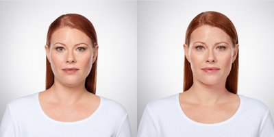 45-54 year old woman treated with Kybella - Two treatments of Kybella