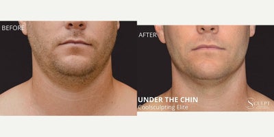 35-44 year old man treated with CoolSculpting Elite - Before & After CoolSculpting Male Chin Area