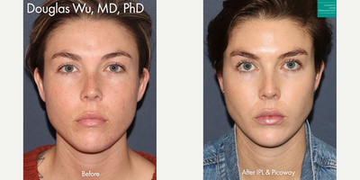 Woman treated with PicoWay - IPL treatment and PicoWay laser to treat brown spots and redness by Dr. Wu