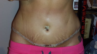 Tummy Tuck Springfield, MO