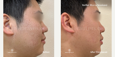 25-34 year old man treated with Stellar M22 - A young man in his mid-20s exhibits freckles and acne scarring on his face. After undergoing four treatment sessions, there are significant improvements observed, with a marked enhancement in the clarity of his skin.