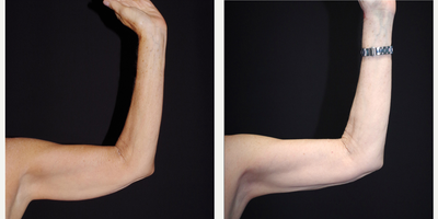 55-64 year old woman treated with Smart Lipo - 64 year old female received Smart Lipo to the arms; photos depict the patient's results 3 months post-op.