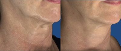 Woman treated with Intracel - Woman treated with Intracel