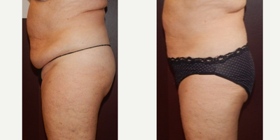 45-54 year old woman treated with Ultraslim - Ultraslim is more effective than Coolsculpting and there is no downtime. Immediate results. You don't have to wait 6 weeks or 3 months for. You get immediate results on each treatment. This is 6 treatments.