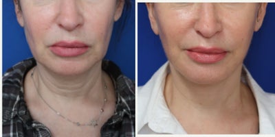 58 year old woman treated with Deep Plane Facelift - 58 year old woman treated with Deep Plane Facelift under IV Sedation.