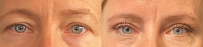 Woman treated with Eyelid Surgery - Woman treated with Eyelid Surgery