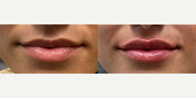 18-24 year old woman treated with Restylane - Dr. Wise created a more symmetrical look for this patient's lips, while subtly adding more volume. The outcome is naturally beautiful!