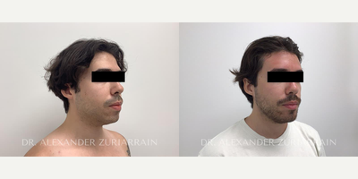 25 year old man treated with Chin Implant - 25 year old man treated with Chin Implant