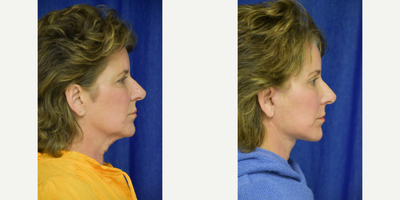 671 65-74 year old woman treated with Lower Facelift, Facelift, Brow Lift, Chemical Peel - 45-54 year old woman treated with Facelift, Neck Lift, Facial Fat Transfer, Eyelid Surgery