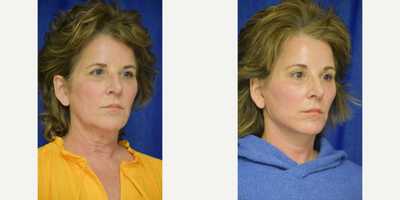 671 65-74 year old woman treated with Lower Facelift, Facelift, Brow Lift, Chemical Peel - 45-54 year old woman treated with Facelift, Neck Lift, Facial Fat Transfer, Eyelid Surgery