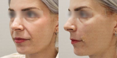 35-44 year old woman treated with Collagen Injection, Thread Lift - This 3544 year-old woman was treated with collagen injections and a thread lift to improve the appearance of nasolabial folds and overall midface laxity. Collagen injections provided natural volume restoration and stimulated new collagen production, while the thread lift delivered an immediate lifting effect. The combined treatment reduced the depth of the smile lines, enhanced skin firmness, and created a smoother, more youthful contour with natural-looking results.