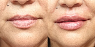 45-54 year old woman treated with Injectable Fillers - The patient underwent lip augmentation with Restylane. The filler adds a natural but sexy appearance to her lips. The pictures show her transformation in this twenty minute procedure. Lip enhancement and replenish the volume patients have lost in their lips as we age, or create the lips they have always desired