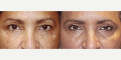 48 year old woman treated with Eyelid Retraction Repair, Eyelid Surgery - 48 year old woman treated with Upper Blepharoplasty, correcting droopiness and rejuvenating the overall eye appearance.