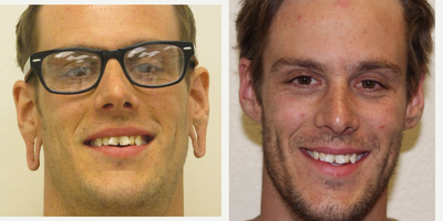 18-24 year old man treated with Ear Lobe Surgery - This gentleman had ear lobe repair after having his ear gauges removed. Dr. Richards was able to provide him with a natural looking result.