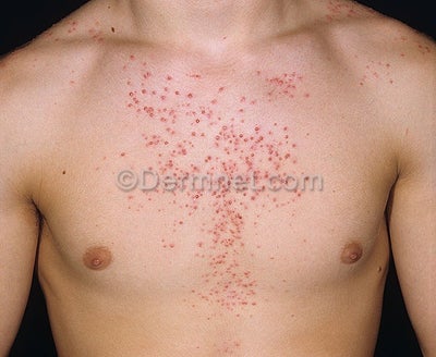 Steroid injection for acne