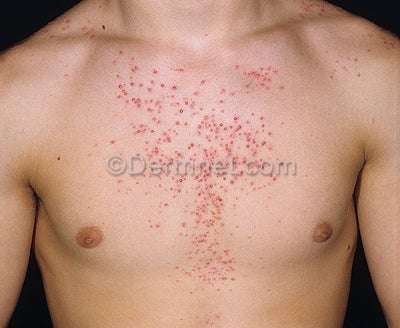 Steroid back spots