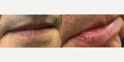 55-64 year old man treated with Lux 1540 - Lux 1540 laser used to treat venous lake on this man's lip.