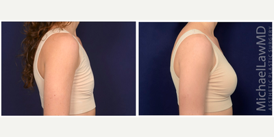 25-34 year old woman treated with Natrelle Breast Implants - Breast augmentation. Follow-up photos taken 3 months after the procedure.