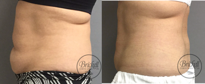 55-64 year old woman treated with UltraShape Power - Final results shown 4 weeks after last Ultrashape Power treatment