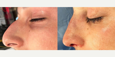 Woman treated with Rhinoplasty - Woman treated with Rhinoplasty