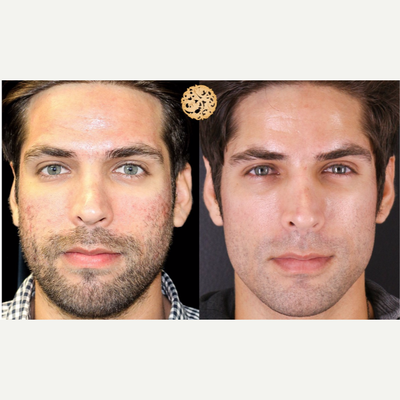 25-34 year old man treated with Vivace - Vivace creates clearer skin with improved texture and reduced scarring.