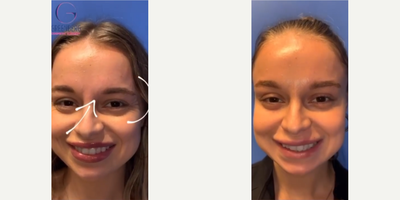 Woman treated with Dysport - Woman treated with Dysport to crows feet, forehead, and glabellar lines, shown 3 days post op.