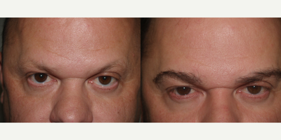 Eyebrow Transplant - Before and after 650 grafts, done by the FUE technique, to male with genetically thin eyebrows.