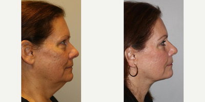 Woman treated with Nonsurgical Neck Lift - Woman treated with Nonsurgical Neck Lift through FaceTite