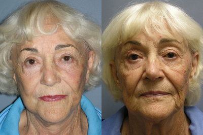79 year old Blue Peel And Lite Lift - 
	The Blue Peel and and a Lite Lift are so age redefining.

