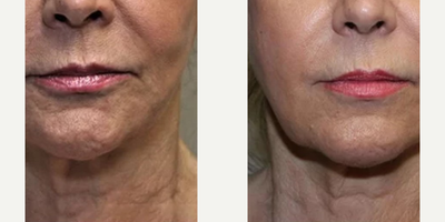 Woman treated with Profound RF - Woman treated with Profound RF