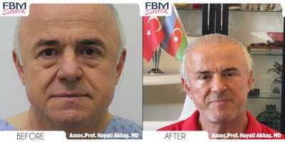 55-64 year old man treated with Deep Plane Facelift, Brow Lift, Facelift, Facial Fat Transfer - 55-64 year old man treated with Deep Plane Facelift, Brow Lift, Facelift, Facial Fat Transfer