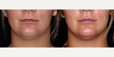 24year old woman treated with Volbella - 24 year old woman treated with Volbella, Lip Fillers. Photos depict before and 1 month after treatment.