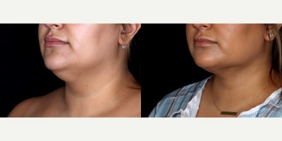 32 year old woman treated with PrecisionTx - 32 year old woman treated with PrecisionTx. Photos depict before and 6 weeks after surgery