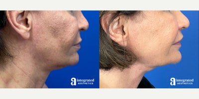 55-64 year old woman treated with AccuTite - This patient is a 56-year-old female who had concerns with her lower face and neck. Dr. Cho performed MyEllevate and accutite. After photos are 3 months post procedure.