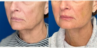 65-74 year old woman treated with Dermal Fillers, Laser Liposuction, Miracu, Nonsurgical Facelift - Facial Rejuvenation in the hands of Dr. Jeffrey Rosenthal, requires a combination of procedures to stimulate collagen with the Endolift Laser, Lift and support sagging face, jaw and neck skin with PDO Threads (Miracu and Mint) and replace lost volume with Radiesse and RHA fillers. Harmony and Balance of the face and neck is the ideal rejuvenation.