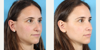 Woman treated with Revision Rhinoplasty - Woman treated with Revision Rhinoplasty