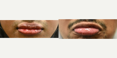 35-44 year old man treated with YAG Laser - For those with sun spots on the lips, the issue can be concerning.  Our patients with Asian, Hispanic or African American heritage often get spots on the lips and lasers are a quick and easy solution.  Laser lip spot removal.  Remove brown spots on the lips.