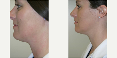 25-34 year old woman treated with TITAN - Skin Tightening with TITAN