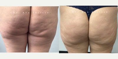 45-54 year old woman treated with Aveli, Skin Tightening - Cellulite treated with Aveli