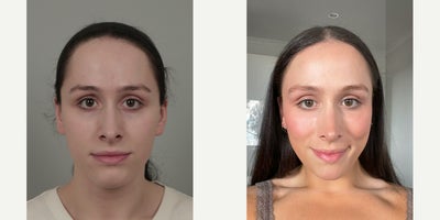18-24 year old woman treated with AccuLift, Cheek Implants, Facial Fat Transfer, Forehead Reduction, Rhinoplasty, V Line Surgery - .