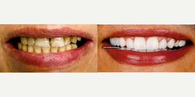 35-44 year old woman treated with Dental Crown, Full Mouth Reconstruction - We gave our patient from Canada a new smile with aesthetic porcelain on zirconium in a short time.The satisfaction of our patients is our greatest motivation.