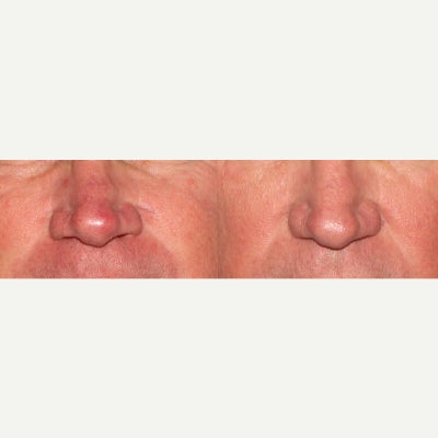 45-54 year old man treated with V Beam - Red capillaries on the nose of a male patient are treated with the VBeam laser.