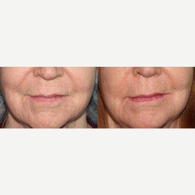 55-64 year old woman treated with Active FX - Active/Deep FX laser treatment is used to diminish lip lines and fine lines around the mouth.