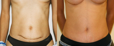 Abdominoplasty Revision - 
	Mini-abdominoplasty perforned by gynecologist-obstetrician at time of C-section resulted in scar that was difficult to conceal, and asymmetric. Revised to full abdominoplasty with longer scar, but positioned lower and more symmetric.
