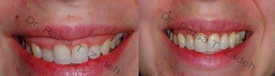 Young Woman Treated For A Gummy Smile - Using gum and bone trimming, I was able to create a well-balanced smile.