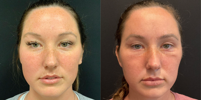 25-34 year old woman treated with Double Eyelid Surgery - Upper and lower blepharoplasty