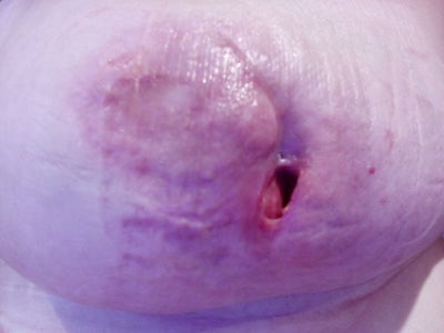 Breast implants - anitahazari