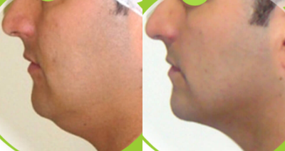 25-34 year old woman treated with Chin Liposuction - 25-34 year old woman treated with Chin Liposuction