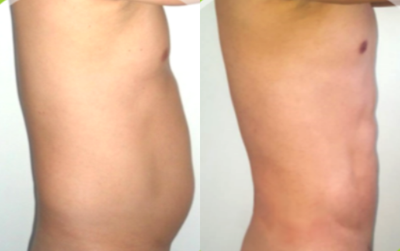 35-44 year old man treated with Abdominal Etching - 35-44 year old man treated with Abdominal Etching